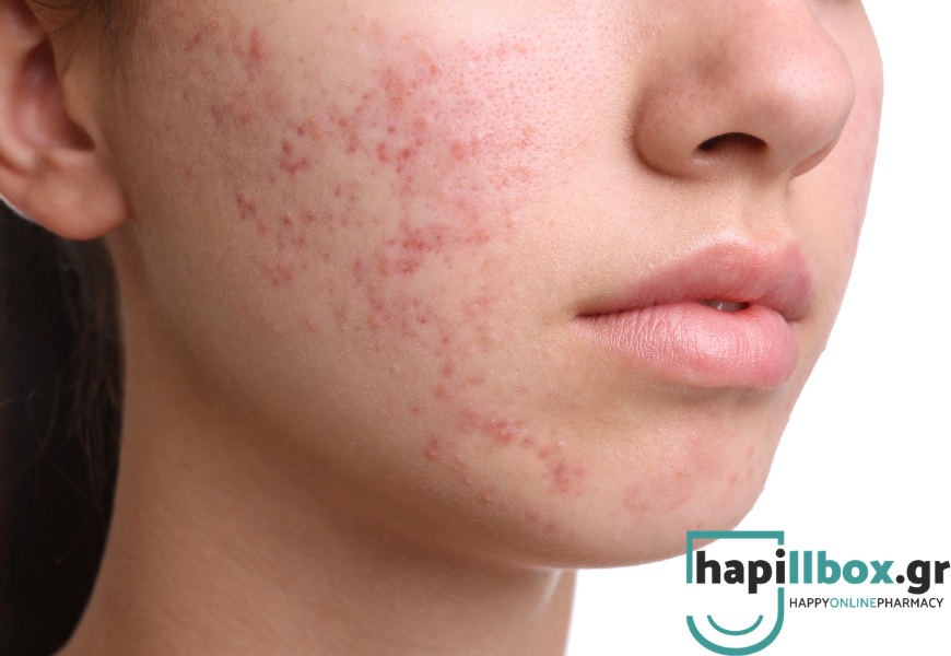 Τι πραγματικά χρειάζεται η επιδερμίδα σου όταν έχεις Λιπαρό Δέρμα με Τάση Ακμής;